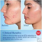 ژل ضدجوش دیفرین 30 گرم - Image 2