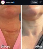 ژل ترمیم کننده جای زخم سیکالفیت پلاس اون 30 میل - Image 2