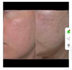 سرم PDRN و هیالورونیک اسید 100 آنوا ۳۰ میل - Image 4